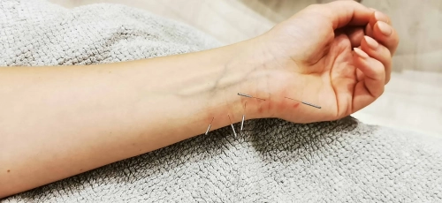 Beata_Acupuncture_1_1_scaled.webp