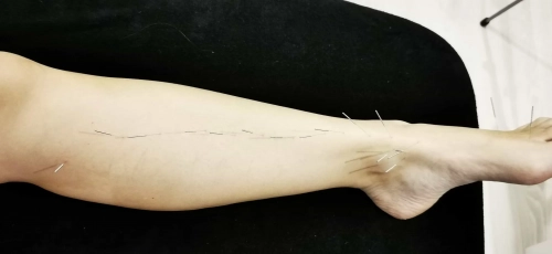 Beata_Acupuncture_2_1_scaled.webp