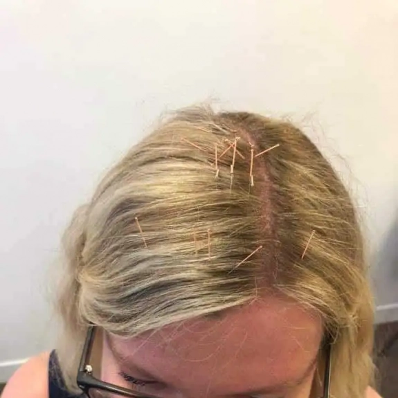 Zhu Scalp Acupuncture - Acupuncture in Reading, Berkshire and Surrounding Areas - Lina Doyle