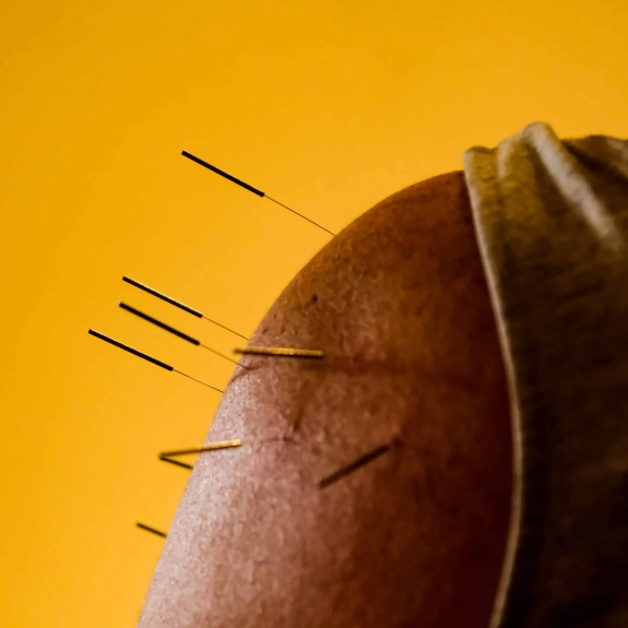 Balance Method Acupuncture By Dr Richard Tan - Acupuncture in Reading, Berkshire and Surrounding Areas - Lina Doyle