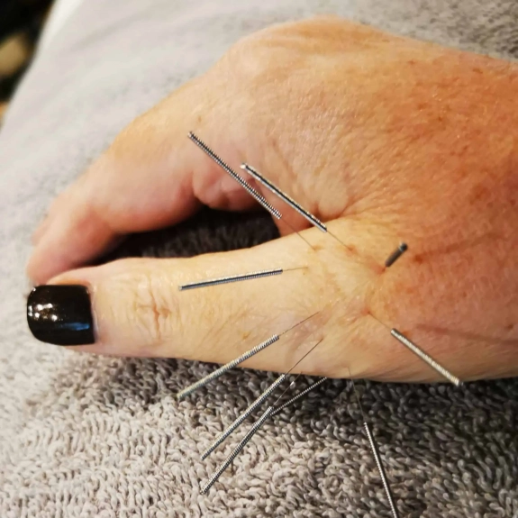 Balance Method Acupuncture By Dr Richard Tan - Acupuncture in Reading, Berkshire and Surrounding Areas - Lina Doyle