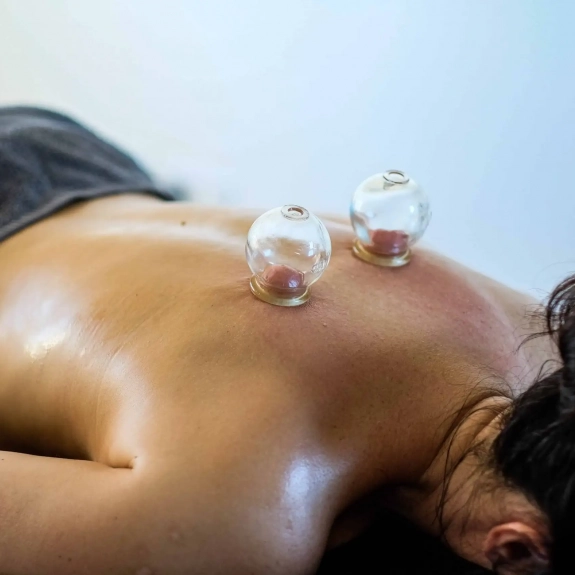 Cupping - Acupuncture in Reading, Berkshire and Surrounding Areas - Lina Doyle