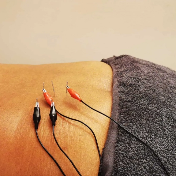 Electro Acupuncture
