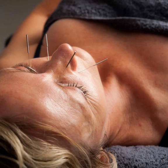 Facial Cosmetic Acupuncture - Acupuncture in Reading, Berkshire and Surrounding Areas - Lina Doyle