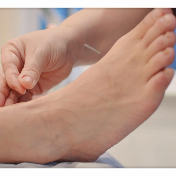 Acupuncture
